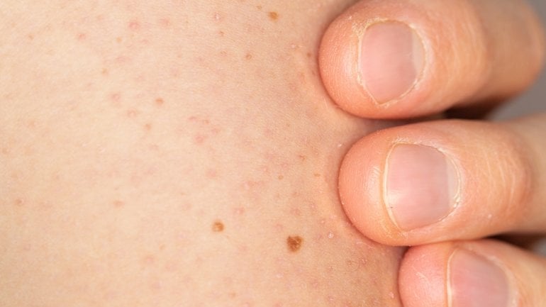 Reibeisenhaut Keratosis Pilaris Ursachen Behandlung Tipps