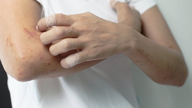 Krätze Scabies Symptome Behandlung gesundheit de