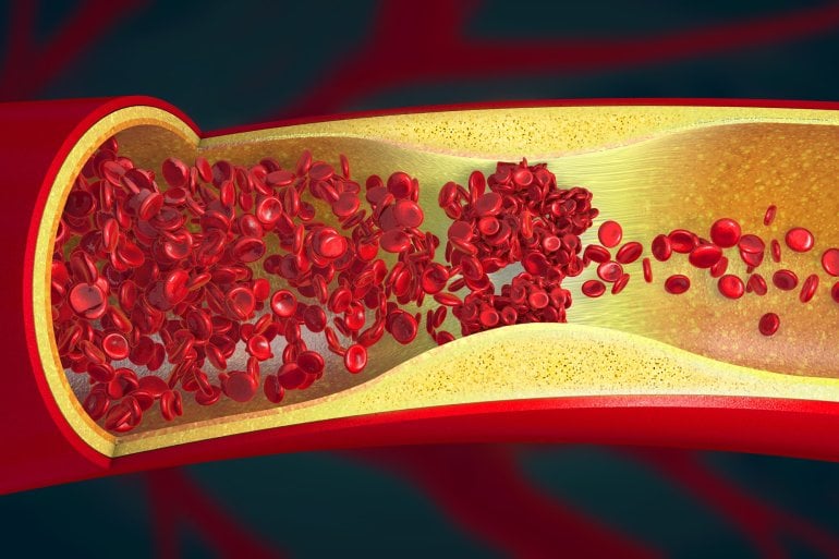 Darstellung von verengten Gefäßen aufgrund Arteriosklerose