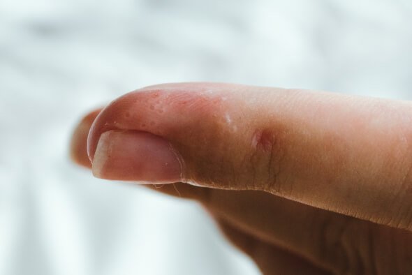 Dyshidrosis am Finger