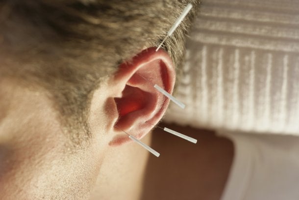 Tinnitus mit Akupunktur behandeln
