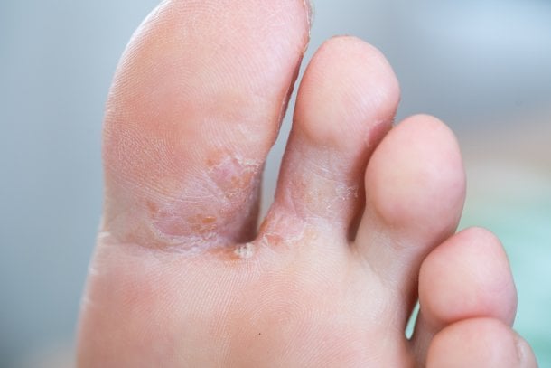 Formen von Fußpilz an Symptomen erkennen