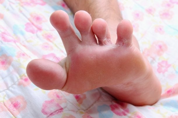 Fußpilz erkennen an schuppender Haut