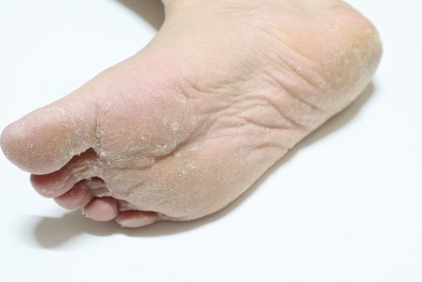 Stark verhornte Haut hilft, Fußpilz zu erkennen