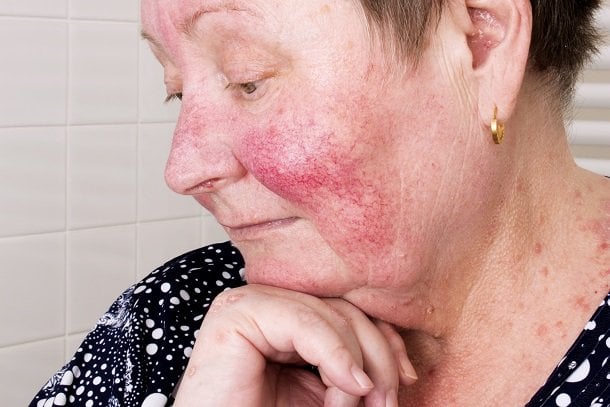 Rosacea