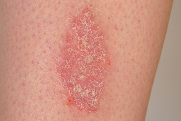 Schuppenflechte (Psoriasis)