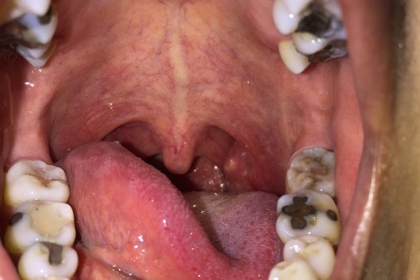 Mandelentzündung (Tonsillitis)