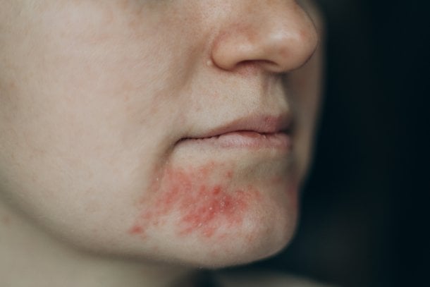 Mundrose (Periorale Dermatitis)