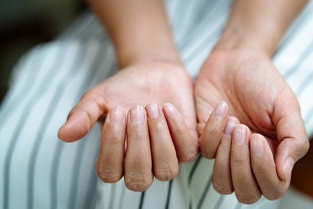 Häufige Nagelveränderungen