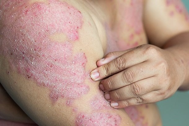 Psoriasis vulgaris