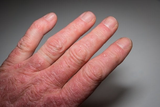 Psoriasis-Arthritis