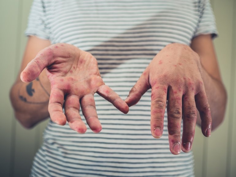 Ausschlag an den Händen bei Hand-Fuß-Mund-Krankheit