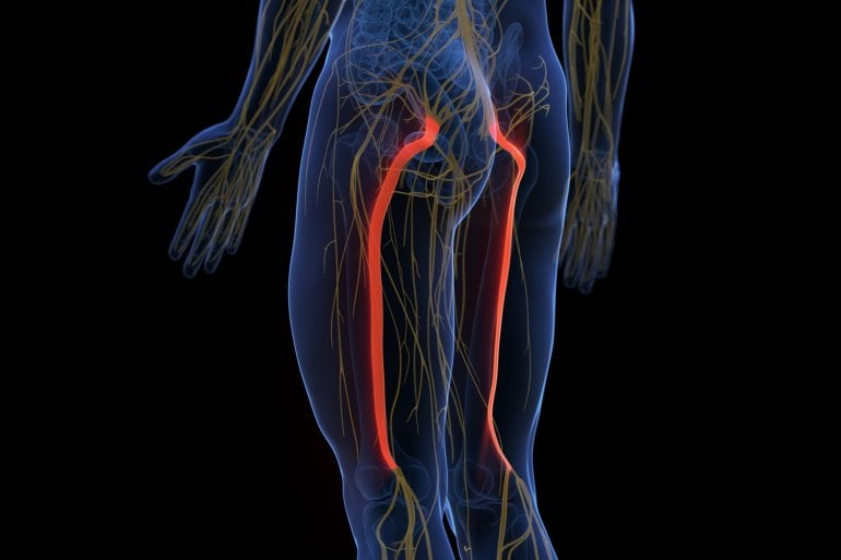 Grafik eines schmerzhaften Ischiasnervs