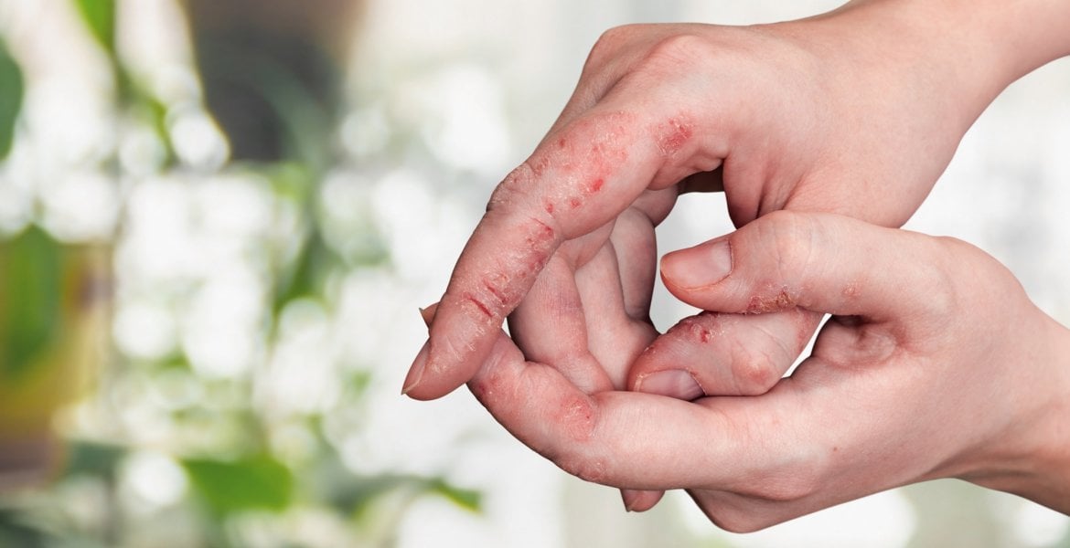 Hände mit Anzeichen von Psoriasis-Arthritis