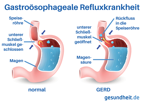 Gastroösophageale Refluxkrankheit (GERD) – Infografik