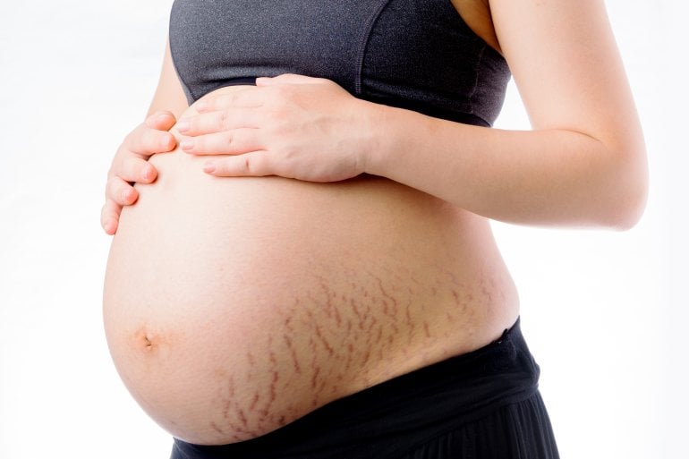 Bauch mit Schwangerschaftsstreifen