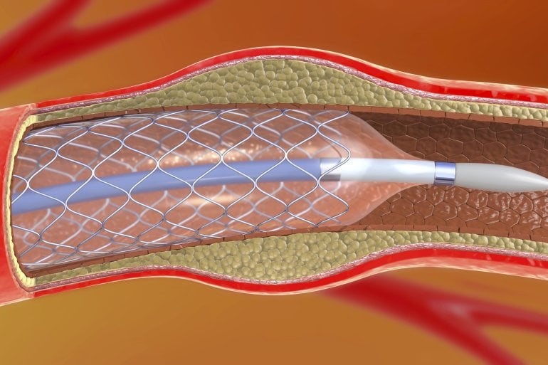 Darstellung einer Stent-Implantation im Herzen