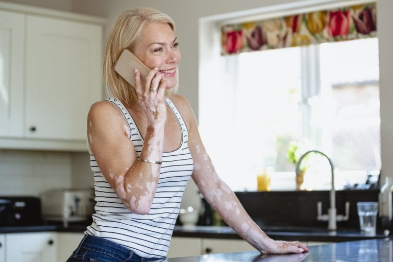 Frau mit Vitiligo telefoniert